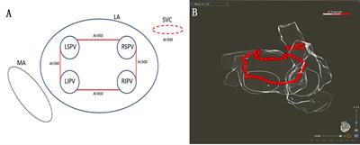 Single ring isolation of pulmonary veins combined with electrical isolation of the superior vena cava in patients with paroxysmal atrial fibrillation